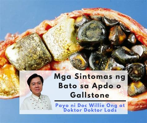 Gallbladder, Gallstones, bato sa apdo, magkano Ang .